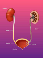 Expert Intervention Radiologist for DJ Stent Procedure | Advanced Urinary Obstruction Care