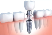 Dental implants in Islamabad Enfield Royal Clinics