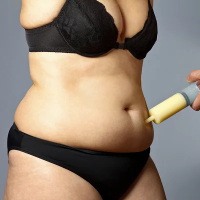 Liposuction surgery in riyadh