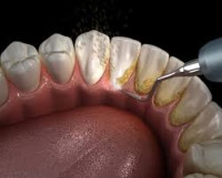 Teeth Scaling in islamabad