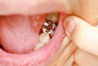 Teeth filling in Islamabad Enfield Royal Clinics