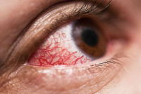 Uveitis Treatment in Ayurveda – Safe & Herbal Remedies