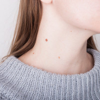 Warts Removal Treatment in Islamabad