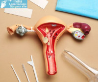 Top Laparoscopic Myomectomy Surgeons in India