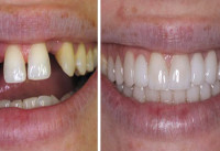 Professional Dental Care Crowns & Bridges Islamabad