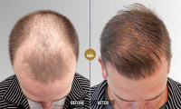 Hair transplant in Islamabad