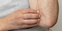 How to identify scabies