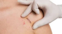 How long does it take for stitches to dissolve