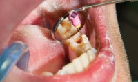 Best Root canal treatment in Islamabad