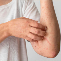 Best Skin Cancer Surgeons in India