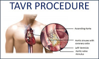 Cost of Trans Catheter Aortic Valve Replacement India