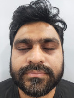 Puffy Eyes Treatment In Andheri